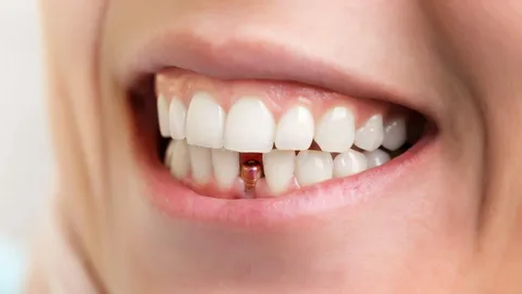 Dental Implant Courses